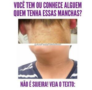 voce tem ou conhece alguem que tenha essas manchas
