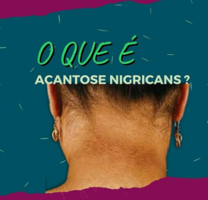 o que e acantose nigricans