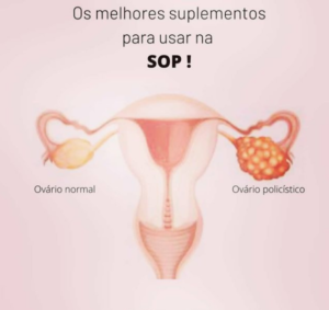 Os Melhores Suplementos para usar na SOP