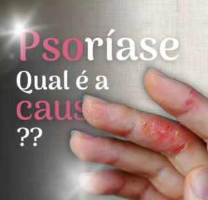 psoriase qual e a causa