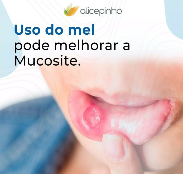 uso do mel pode melhorar a mucosite
