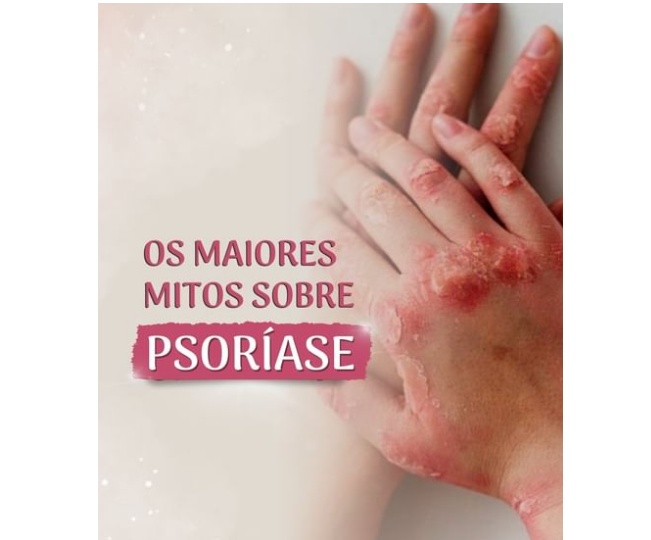os maiores mitos sobre psoriase
