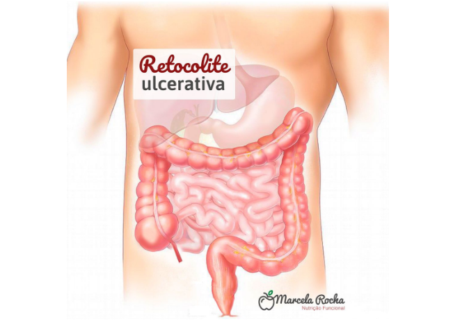 sobre retocolite ulcerativa