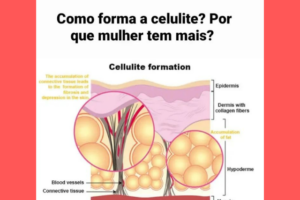 Como Forma a Celulite?