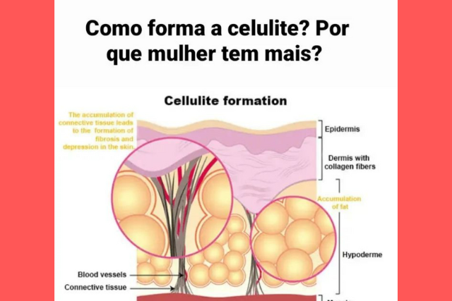 Como Forma a Celulite?