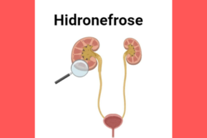 Sobre Hidronefrose