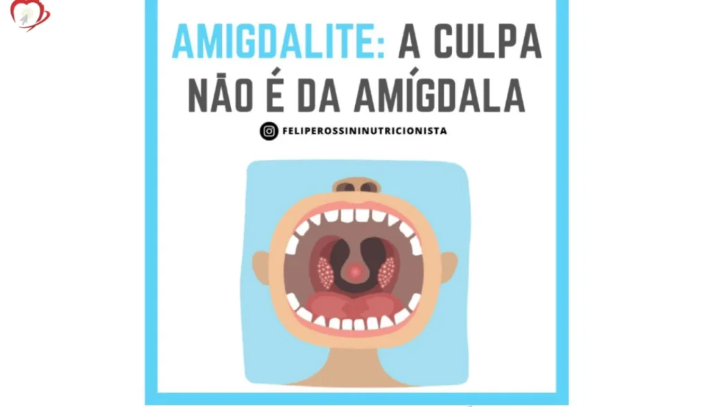 Amigdalite - A culpa não é da Amígdala